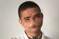 Samuel Rodrigues muestra las marcas dejadas por accidente. Hoy respira por traqueotomía. Foto: ARCHIVO PERSONAL