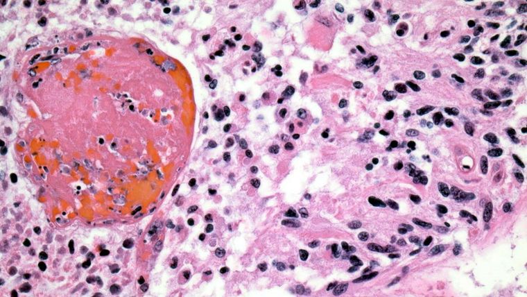 Así se observa un glioblastoma. Foto: Colegio de Patólogos Americanos / Sputnik