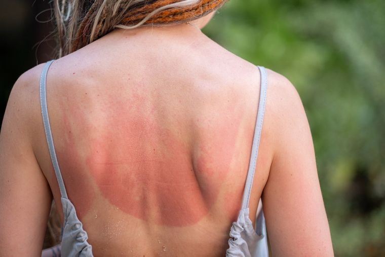 Evitar el sol en horarios críticos durante el verano reduce el riesgo de quemaduras. Foto: Shutterstock