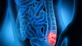 Existen distintas pruebas efectivas para detectar a tiempo el cáncer de colon. Foto: Archivo MDZ Existen distintas pruebas efectivas para detectar a tiempo el cáncer de colon. Foto: Archivo MDZ