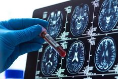 4 avances esperanzadores para la enfermedad de alzheimer este ano 4 avances esperanzadores para la enfermedad de alzheimer este ano
