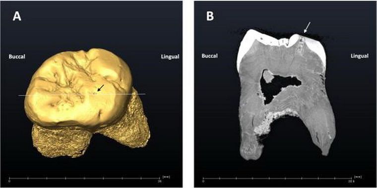 La arqueología se ocupó del séptimo caso conocido de una caries dental en un neandertal. Foto Dpa La arqueología se ocupó del séptimo caso conocido de una caries dental en un neandertal. Foto Dpa