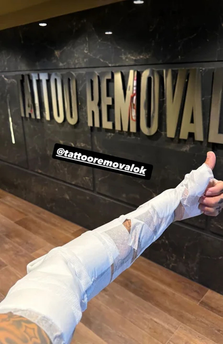 Alex Caniggia en pleno proceso de remoción de tatuajes. Alex Caniggia en pleno proceso de remoción de tatuajes.