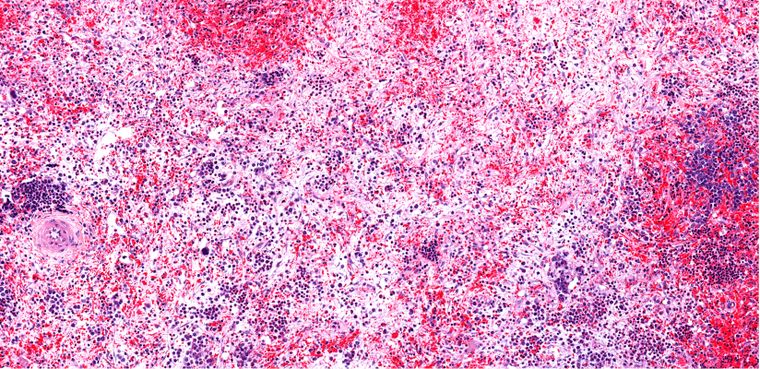 Según GSK, en Argentina 1 de cada 3 pacientes con mielofibrosis sufre anemia y casi el 100% la desarrollará con el tiempo
