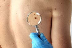 La vacuna está indicada para aquellas personas que fueron operadas de un melanona. Foto: Shutterstock
