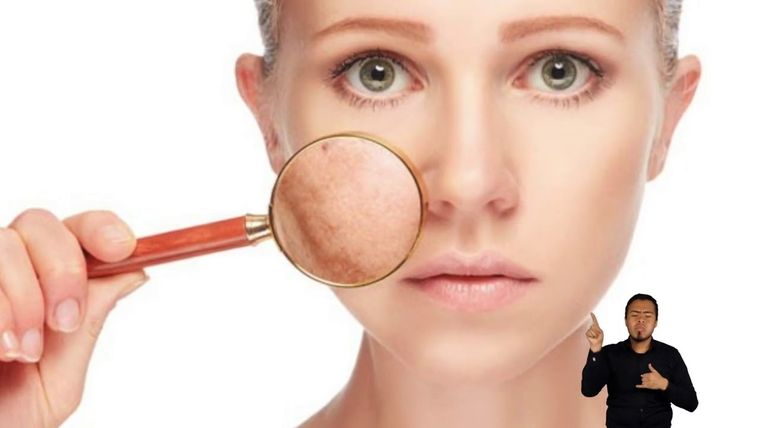 Existen dos tipos de cáncer de piel más comunes y estos son el carcinoma basocelular y el carcinoma espinocelular Foto: Foto gentileza: Youtube