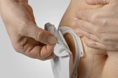 MDZol | Los pacientes ostomizados son personas sanas. Foto: Gentileza