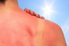 ¿como cuidar la piel durante la primavera-verano?