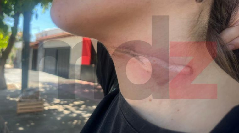 El cuello de la joven herida tras chocar con un cable suelto en Godoy Cruz.