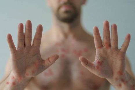 La viruela del mono provoca lesiones en el cuerpo La viruela del mono provoca lesiones en el cuerpo