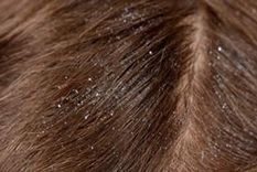 ¿por que aparece la caspa?