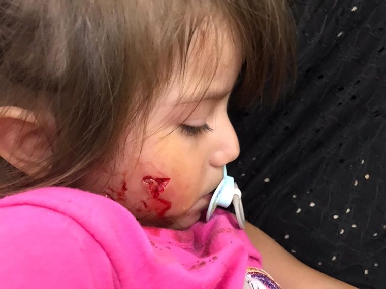 El rostro de la pequeña tras el ataque del perro que su dueña no quiso reconocer