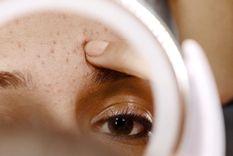 Acné en adultos: ¿por qué persiste aunque no seamos adolescentes? Foto: Eucerin