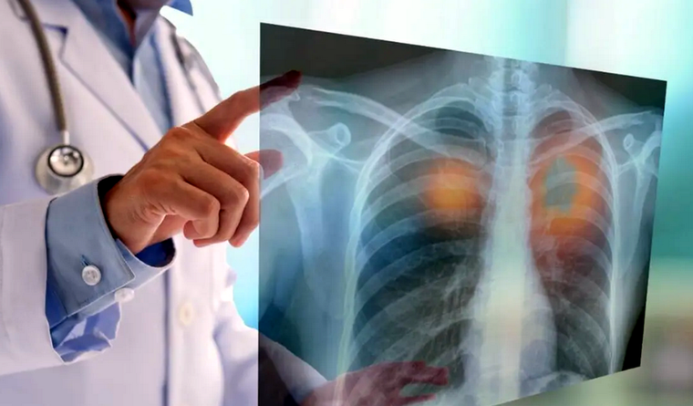 pulmones Nuestros órganos vitales están invadidos por microplásticos. Foto: Nius.