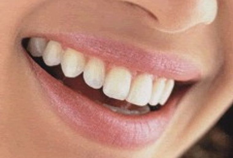 ¿Es peligroso blanquear los dientes? Foto: web