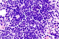 El mieloma múltiple es el segundo cáncer más común en la sangre y ahora apareció un nuevo avance que podría prolongar la vida del paciente. Foto: Noticias Argentinas