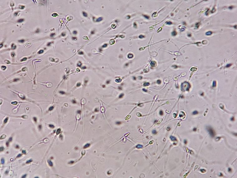 Mientras que en condiciones normales el esperma contiene millones de espermatozoides, en aquellos azoospérmicos casi no se encuentran.