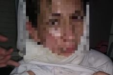 La mujer sufrió graves quemaduras en su rostro tras el ataque de su pareja La mujer sufrió graves quemaduras en su rostro tras el ataque de su pareja