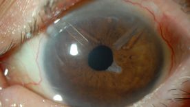 El glaucoma es un grupo de enfermedades en las que se produce un daño progresivo del nervio óptico.