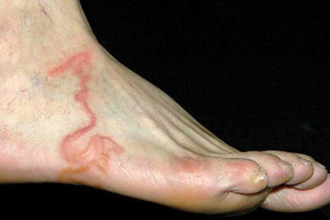 Cuando los doctores examinaron su pie quedaron espantados