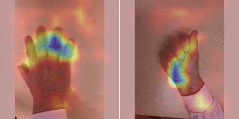 El equipo de la Universidad de Kobe utilizó únicamente imágenes del dorso de la mano y del puño cerrado para detectar señales de acromegalia. El equipo de la Universidad de Kobe utilizó únicamente imágenes del dorso de la mano y del puño cerrado para detectar señales de acromegalia.