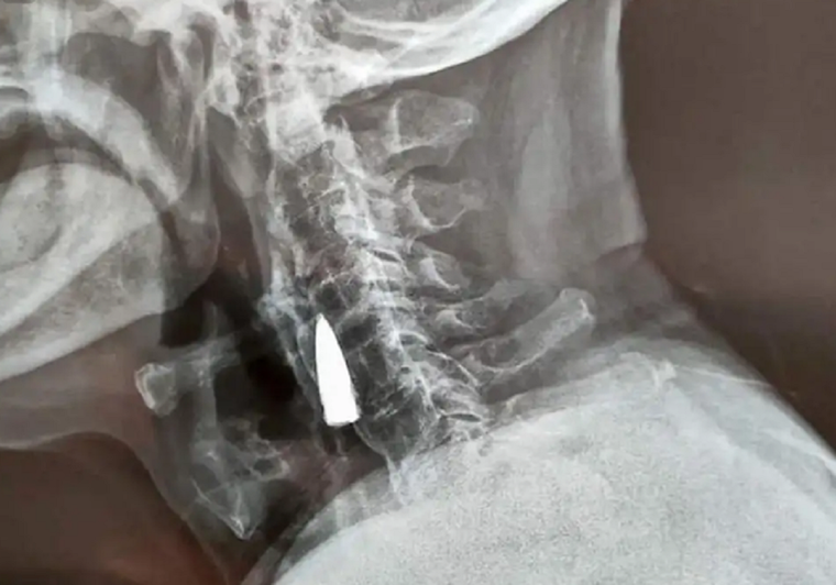 Durante unos 77 años, tuvo una bala alojada en el cuello