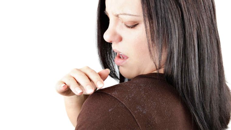 ¡Dile adiós a la capa! estos son los mejores tips para combatirla y lucir un cabello radiante y sano Foto: Archivo