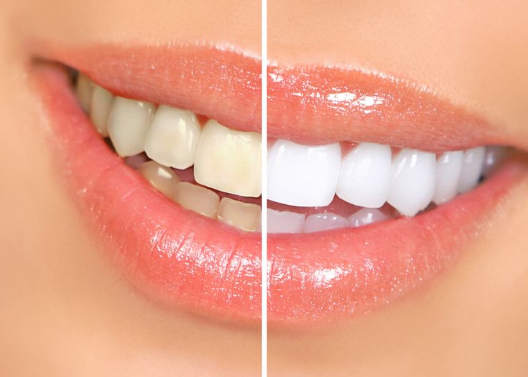 Con este truco casero se podrá blanquear los dientes sin necesidad de gastar dinero Foto: Shutterstock
