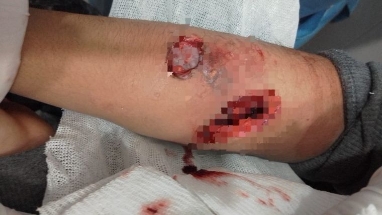 Las mordidas que le produjo el perro Foto: Twitter: @MATIPASCUALETTI