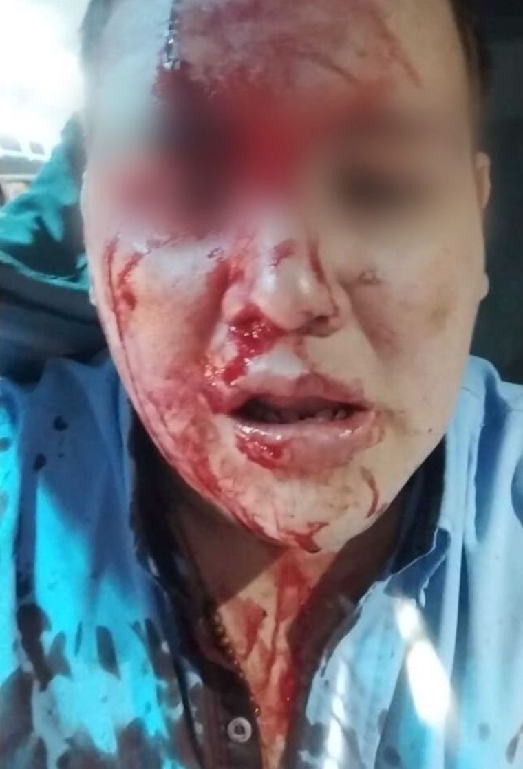 Así queó Kevin tras el botellazo