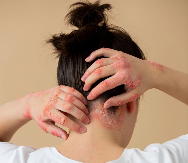 Argentina es el segundo país de Latinoamérica en aprobar esta nueva terapia que consiste en una dosis oral diaria Foto: Freepik