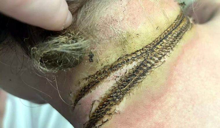 El cuello de Rayce llevará esas marcas de por vida, a menos que se haga una cirugía especial. Foto: X/@merlgaza.